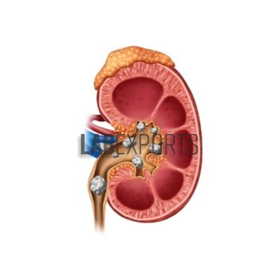 Kidney Stone